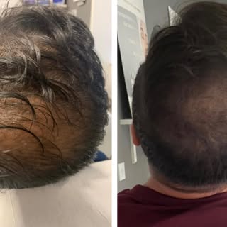 Final session of Scalp Micro Pigmentation for this guy 😎👌

Hair looks so much thicker disguising t