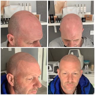 Final tweak for this client today 😎🖤

Scalp Micro Pigmentation is a hair loss solution,  perhaps a