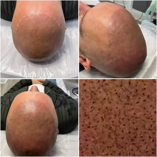Scalp Top up session for Mr M (aka The Husband) 🖤

#smp #scalpmicropigmentation #hairlosssolution #