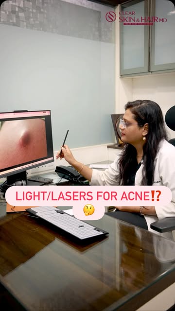 ✨ IPL or Fotona Laser — which one is right for acne? ✨

At Clear Skin, we primarily use IPL (Intense