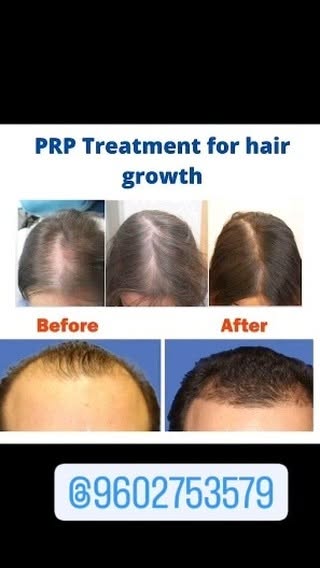 #hair PRP treatment
#hair 
#hair regrowth