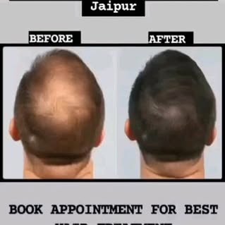 Hair treatment
#PRP
#GFC
#HAIR TRANSPLANT
CALL & BOOK APPOINTMENT @9602753579