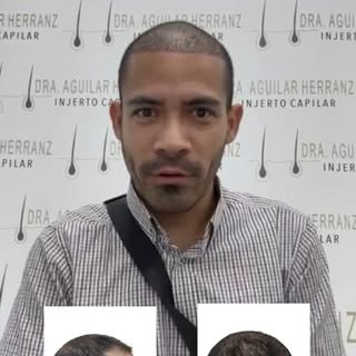 Gracias Miguel Rafael por confiar en @clinicadraaguilar 

¿Tú también quieres recuperar tu imagen?
H