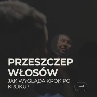 Czy wiesz, jak naprawdę wygląda przeszczep włosów krok po kroku?
To precyzyjny, wieloetapowy proces,