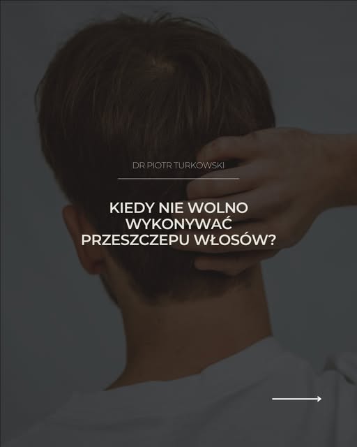 6 sytuacji, w których odmówiłbym wykonania przeszczepu włosów.

Przeszczep włosów nie zawsze jest na