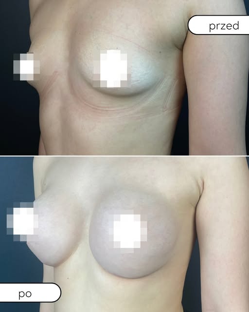 Powiększenie piersi implantami to nie tylko kwestia większego rozmiaru. W tym przypadku zależało nam