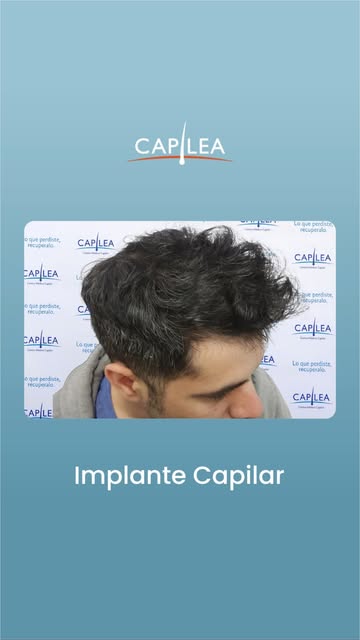 Fue así como volvió a sentirse cómodo con su propia imagen gracias a un implante.

📅 Accedé a tu di
