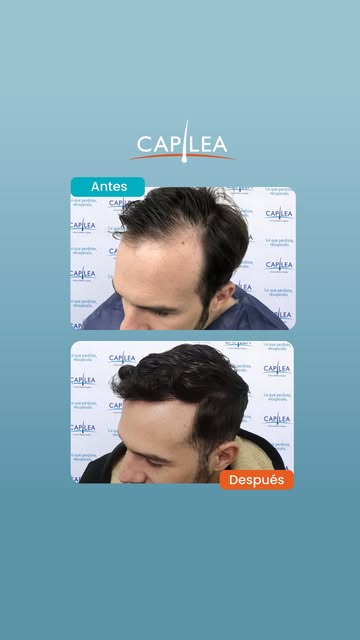 Antes evitaba las fotos de frente.

Después de su implante capilar, ya no evita el espejo.

Ese es e