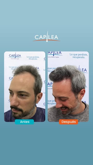 Después de varias sesiones de mesoterapia capilar, el cambio se nota en la densidad del cabello.

Ca