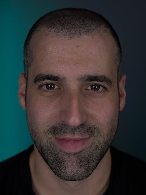 Diego pensaba que tenía mucha menos alopecia de la que realmente había… hasta que vio su cabeza desd