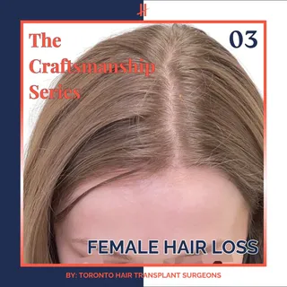 Female hair loss doesn’t always call for the same solution.

Many women experience more diffuse thin