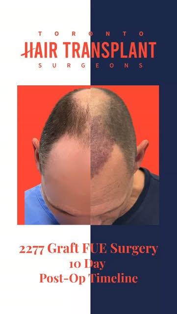 🧐 Curious what recovery from a hair transplant looks like?

This reel showcases a 10 day recovery t