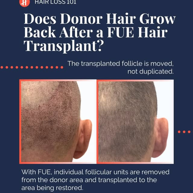 One of the most common misconceptions about hair transplantation is that donor hair simply “grows ba
