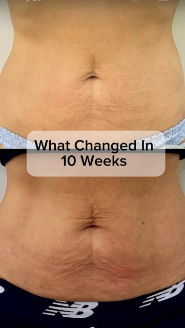 🟢Around 10 weeks after Endolift.

✅What I like about this result is not only the change in the abdo