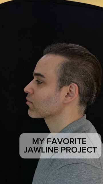 He already had a good jawbone, and there wasn’t much fat hiding it. So why wasn’t the jawline define
