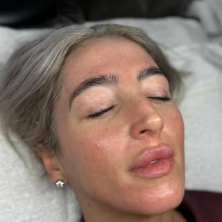 ✨ Tiny needles… BIG skin results ✨

Microneedling is one of the most powerful treatments for transfo