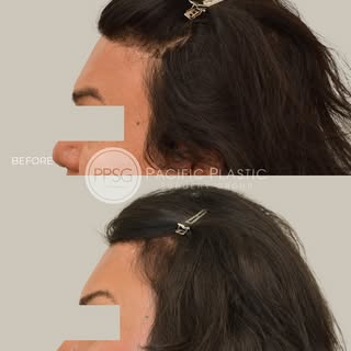 This patient wanted us to conceal her FFS scar with a gender affirming hair transplant. She wanted s