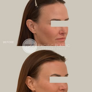 This patient struggled with her facial proportions for many years until discovering hairline lowerin