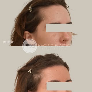 A high hairline can make the face appear longer or less harmonious. Hairline lowering surgery reshap
