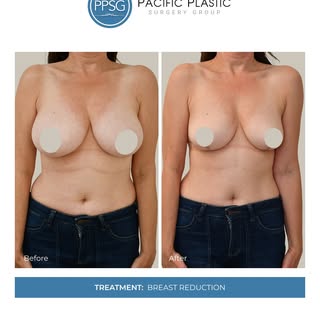 Breast reduction can relieve physical discomfort while creating a more balanced, proportionate silho