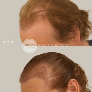 Early results for this patient’s hair transplant – grafts take approximately six months to reach ful