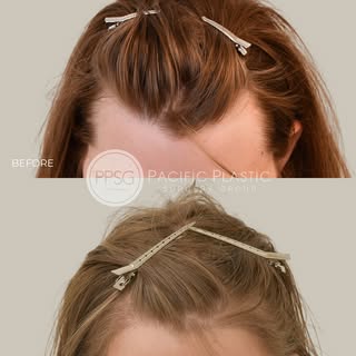 Another wonderful gender affirming hair transplant result – the patient wanted to fill in her widow’