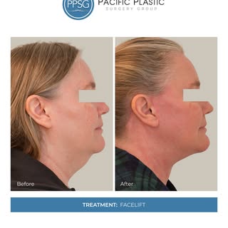A facelift restores definition by repositioning deeper tissues and refining the jawline and neck. Th