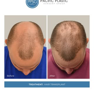 Subtle changes can make a noticeable impact. By rebuilding density along the hairline and crown, thi