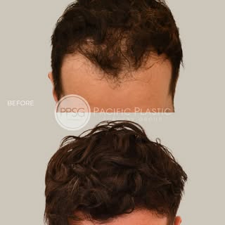 Every graft matters. Strategic placement and attention to direction allow transplanted hair to grow 