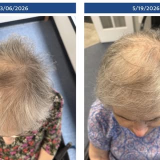Trusting the process of a Certified Trichologist. Understanding the science of hair loss and being t