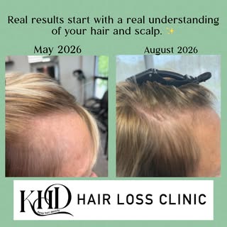 Real results start with a real understanding of your hair and scalp. ✨

This client’s transformation