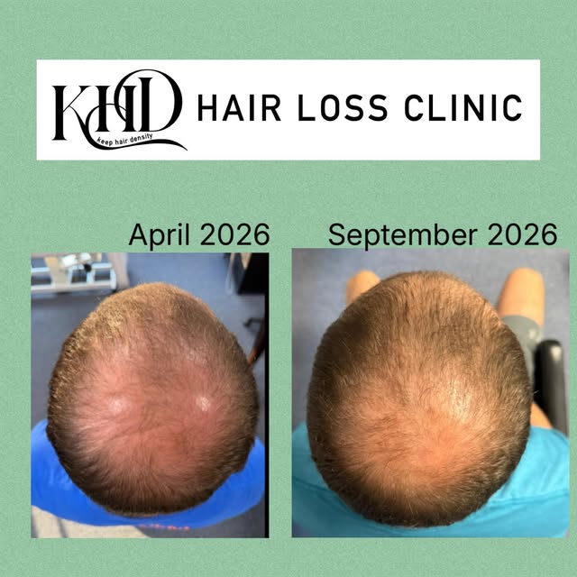 Consistency wins. ⭐️⭐️⭐️⭐️⭐️
Five months, one simple routine, real results.

This client committed t