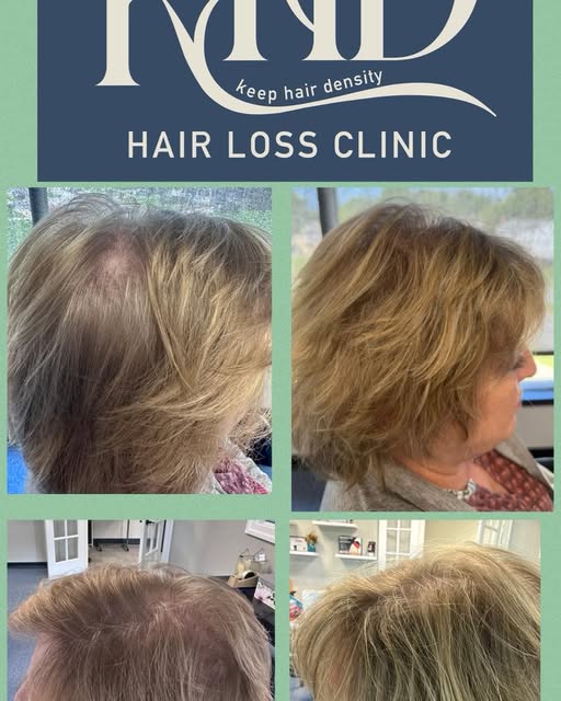 12 weeks. Fuller-looking hair. 💚
Before and after: this client completed a 6-week growth factor tre