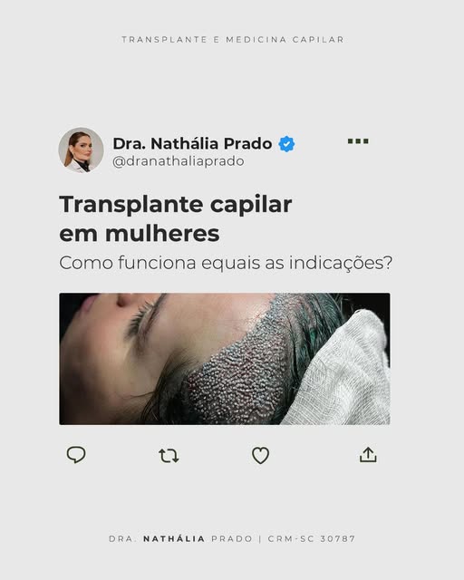 O transplante capilar em mulheres possui particularidades técnicas e diagnósticas muito específicas.