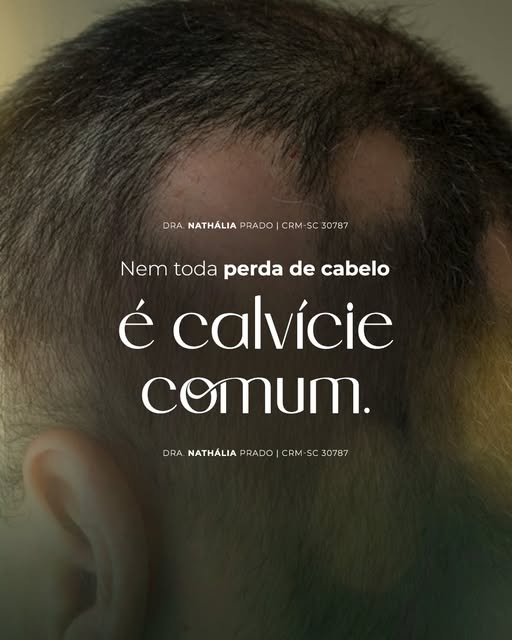 Confundir uma alopecia inflamatória ou cicatricial com queda de cabelo comum pode custar a perda irr