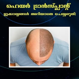 Are you someone who is planning to do a hair transplant surgery? If so, this video is for you. #tran