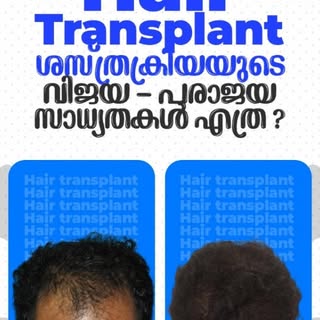 Hair Transplant: വിജയം മുതൽ അപകടം വരെ – അറിയേണ്ട കാര്യങ്ങൾ ⚠️

👉 Watch the full byte now.
https://y