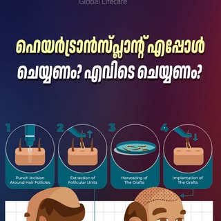 ഹെയർ ട്രാൻസ്‌പ്ലാന്റ് എപ്പോൾ ചെയ്യണം? എവിടെ ചെയ്യണം? | Explained by Dr Harikumar Menon