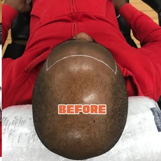 SMP 
Scalp pigmentation delivers a remarkably natural appearance, even upon close inspection.
Low Ma