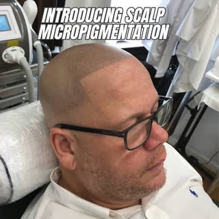 SMP
Scalp Micro Pigmentation is a cutting-edge solution for those dealing with hair loss or thinning