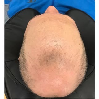 SMP 
Scalp pigmentation delivers a remarkably natural appearance, even upon close inspection.

Low M