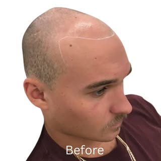 SMP 
Scalp pigmentation delivers a remarkably natural appearance, even upon close inspection.

Low M