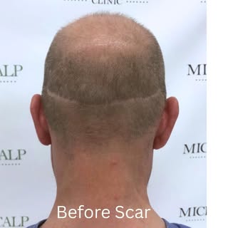 Scar repair (SMP), is a cosmetic procedure that can help camouflage scars on the scalp, including th