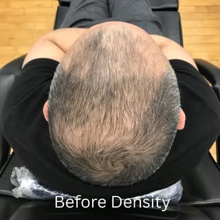 SMP
Do you know anyone with this issue? 
Scalp Micro Pigmentation can help? We can blend and camoufl