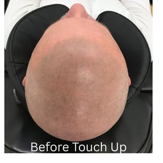 SMP

At Micro Scalp Clinic Springfield, we specialize in restoring your confidence and revitalizing 