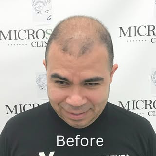 SMP is known for its ability to create a natural-looking hairline and replicate the appearance of a 