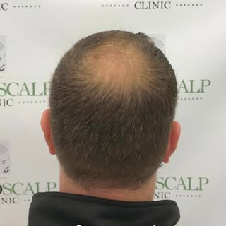 SMP

Do you know anyone with this issue? 
Scalp Micro Pigmentation can help? We can blend and camouf