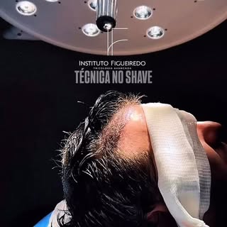 Transplante sem raspar o cabelo? Sim, é possível! 

Neste caso, realizamos um transplante capilar ma