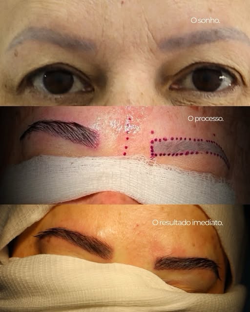 O antes. O depois O resultado imediato! 
Transplante de sobrancelhas: a revolução da harmonização fa