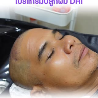 หลังปลูกผมด้วยเทคนิค DHI 1–2 วัน 🩺✨

การดูแลทำความสะอาดสะเก็ดแผลอย่างถูกวิธีตามคำแนะนำของแพทย์ มีส่